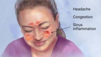 راه‌های طبیعی درمان سینوزیت