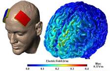 کاهش روند بازیابی پس از سکته، با فناوری «هک مغز» 