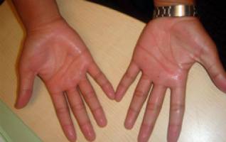 علایم سرطان در دست ها 