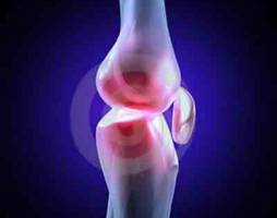 «استامینوفن» به تسکین درد آرتروز کمک نمی‌کند