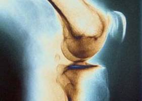 نارسایی کلیوی با بیماری‌های استخوانی چه ارتباطی دارد؟ 