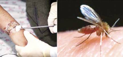 سالانه ۲۵ هزار ایرانی مبتلا به سالک می شوند