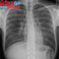 سالانه 4،6 میلیون نفر در جهان به خاطر بیماری های تنفسی می میرند!