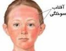 6 راهکار اورژانسی برای درمان آفتاب سوختگی