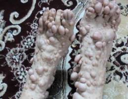 انجمن بیماری نادر نوروفیبروماتوز تشکیل می شود