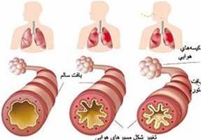 نبایدهای غذایی در مبتلایان به آسم از منظر طب سنتی 