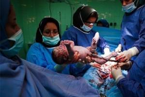 افزایش خطر چاقی در کودکان سزارینی